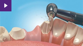 Dental Bridges