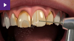 Porcelain Veneers